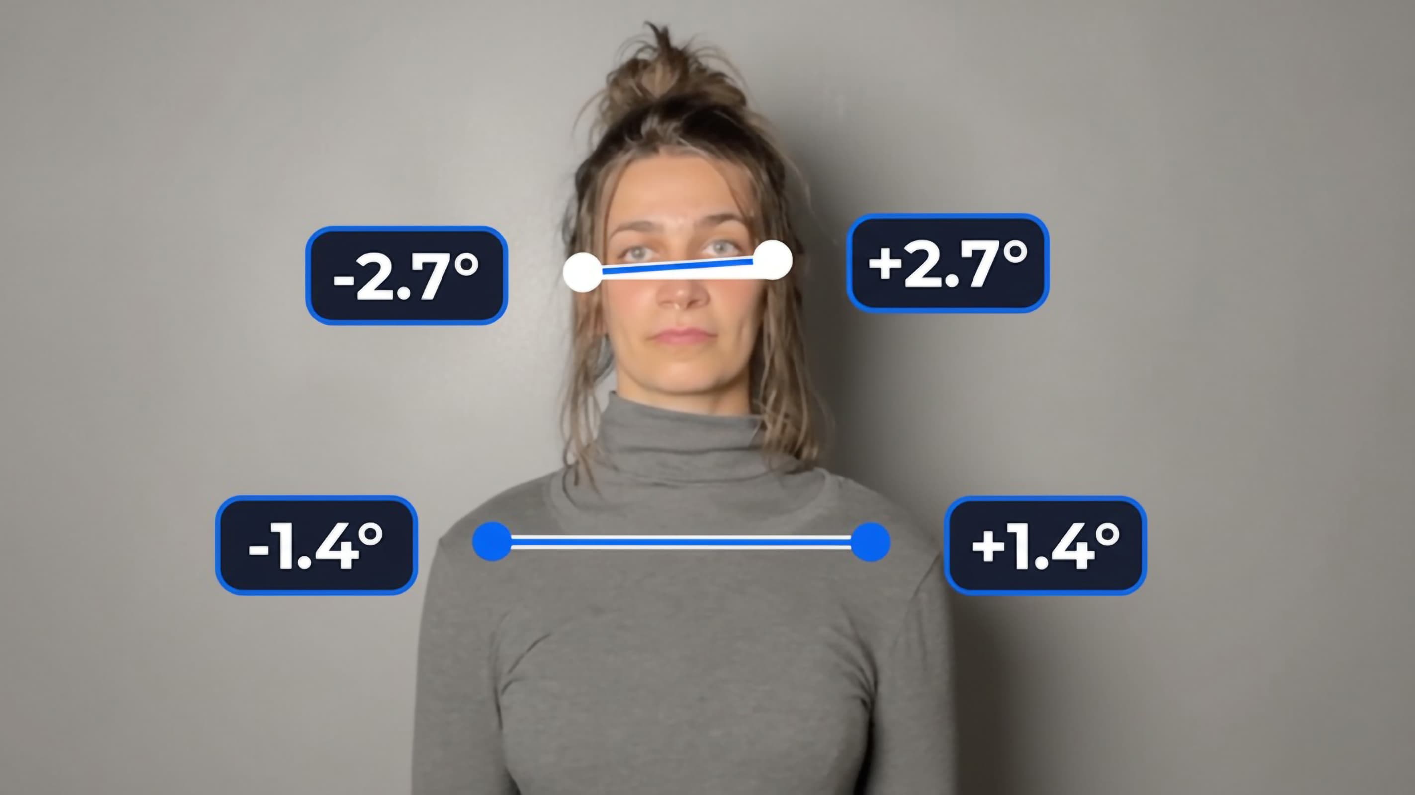 Computer vision analysis of head and shoulder alignment, showing posture measurements generated from a front-facing patient image.